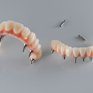 Screw-Retained Implant Bridge.
